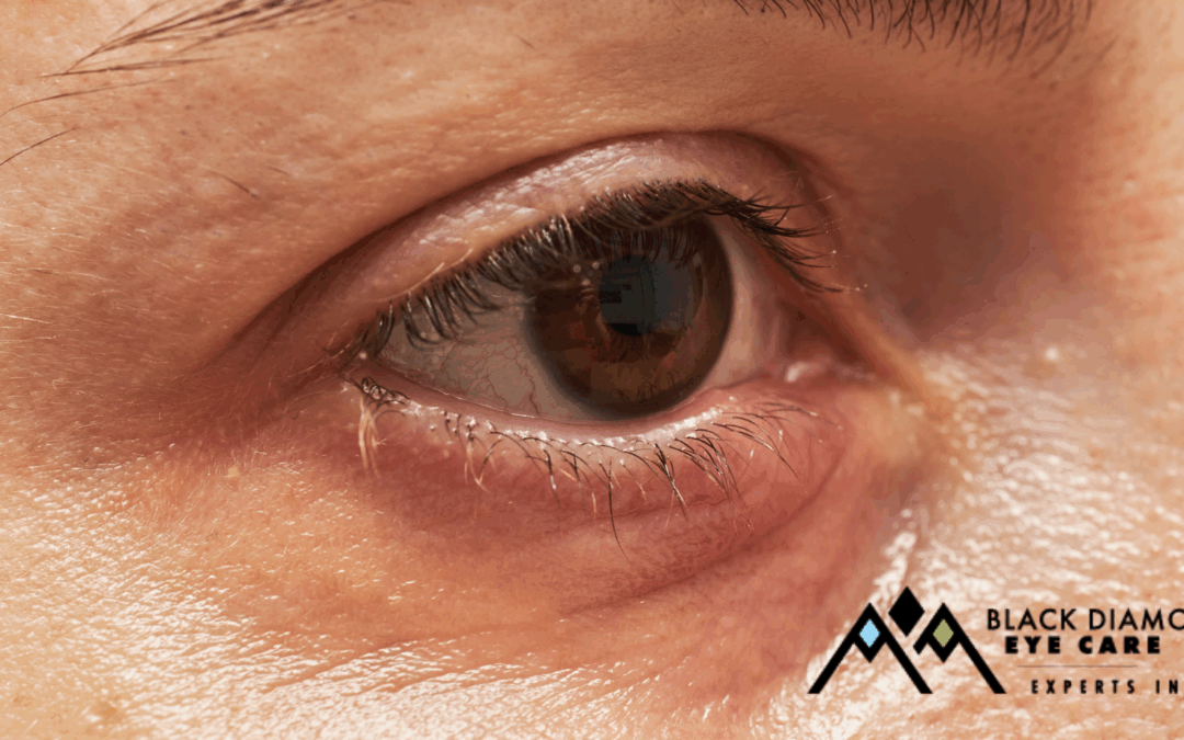 Blepharitis vs Stye: What’s the Difference and How are They Treated?